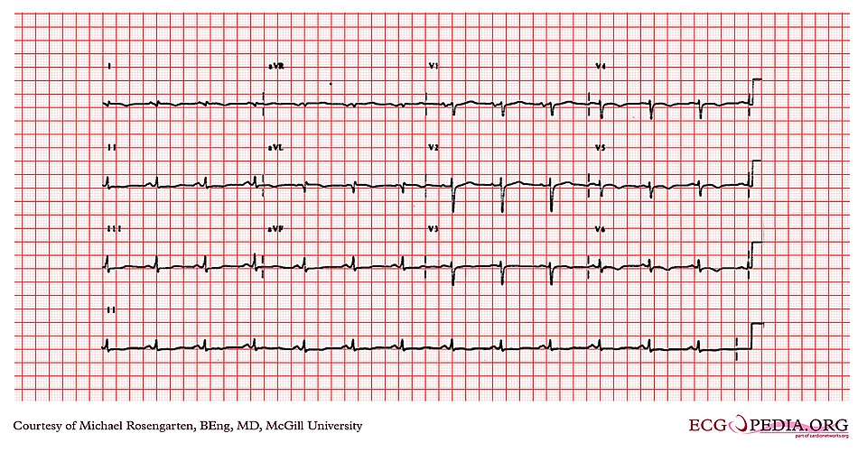 E268 (CardioNetworks ECGpedia)