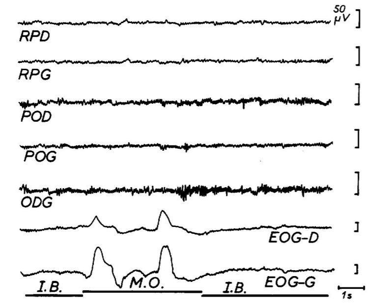 Effets d'une dose orale de 10 mg de T.H.C. sur l'EEG humain